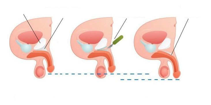 enlargement of the penis after surgery